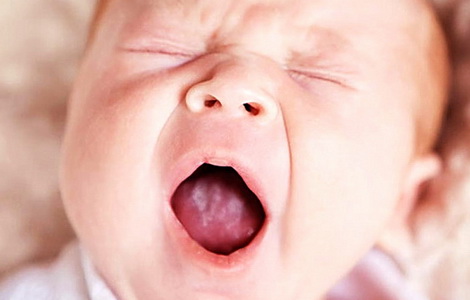 молочница у новорожденного во рту