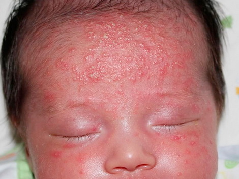 стафилококк у новорожденного симптомы